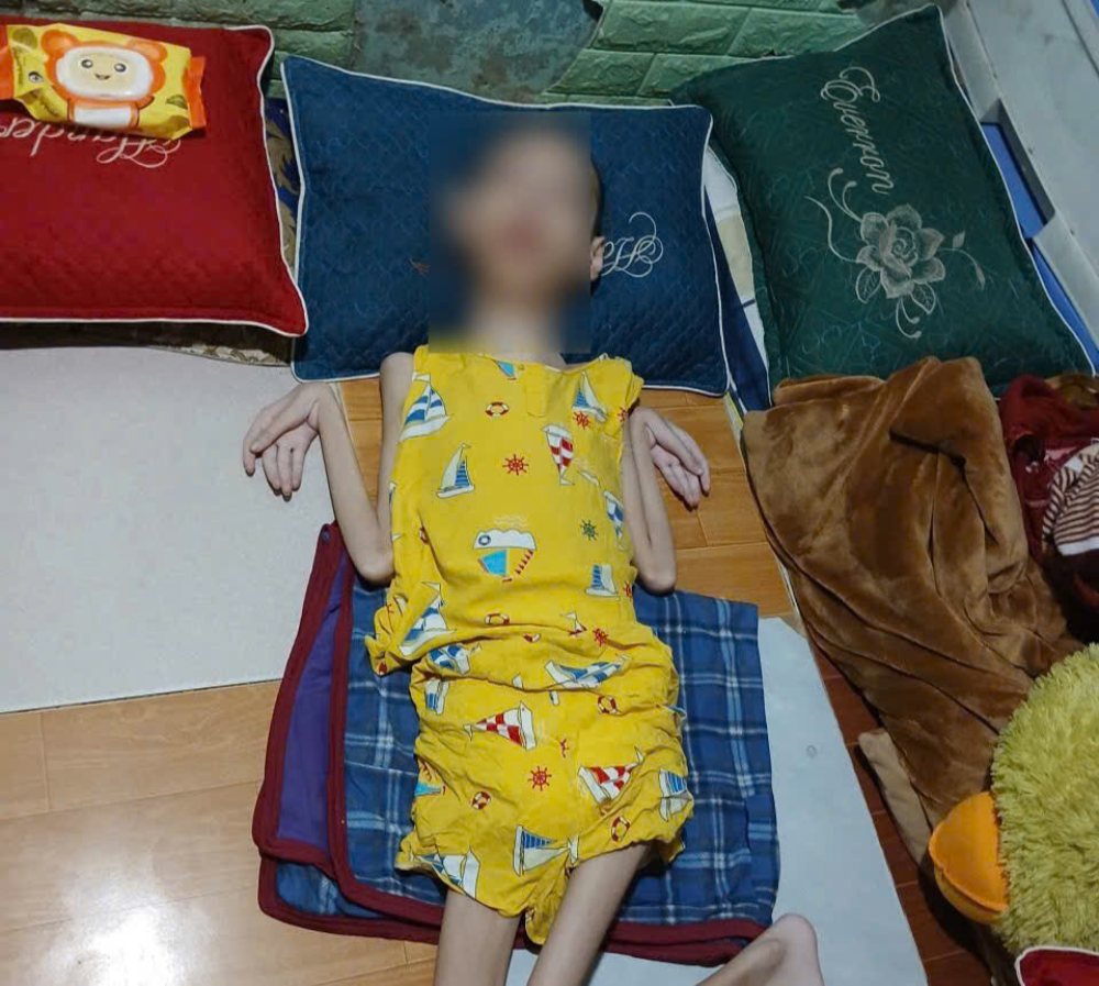 Cháu Võ Văn Tài mắc bại não kèm động kinh. Ảnh: Gia đình cung cấp