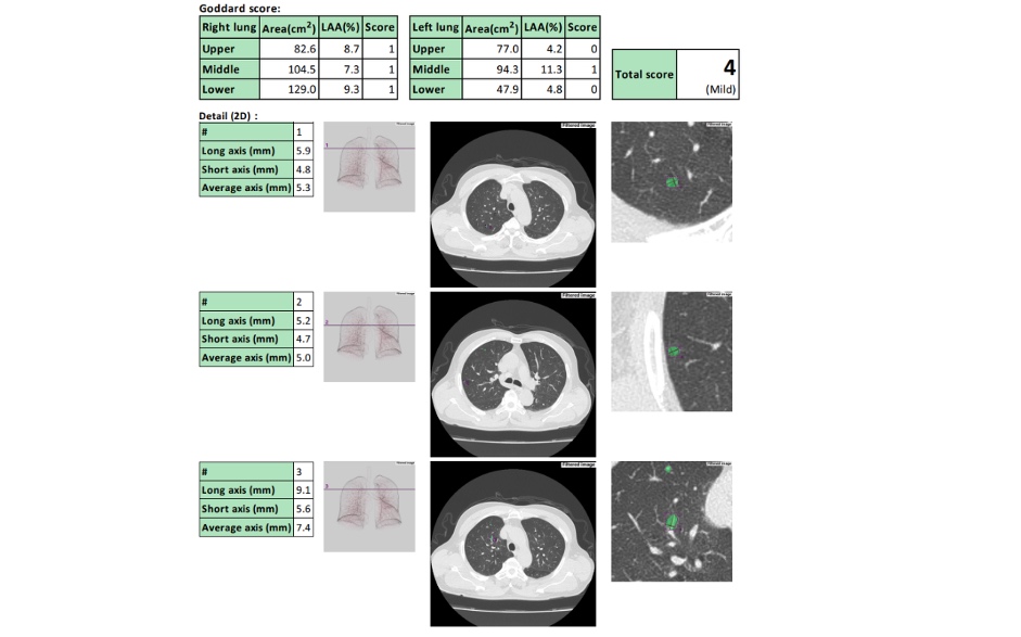 Ảnh chụp CT phổi, AI đánh giá điểm Goddard (mức đánh giá mức độ COPD) = 4, tức phổi tắc nghẽn mạn tính giai đoạn nhẹ. Các nốt ở phổi kích thước từ 5.3 - 7.4mm. Ảnh: NURA Việt Nam