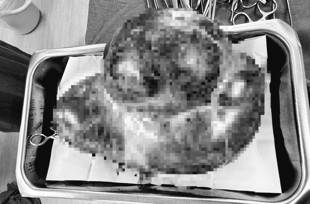 El tumor de casi 5 kg fue extirpado del cuerpo de la paciente por los médicos. Foto: Hospital General de Quang Tri