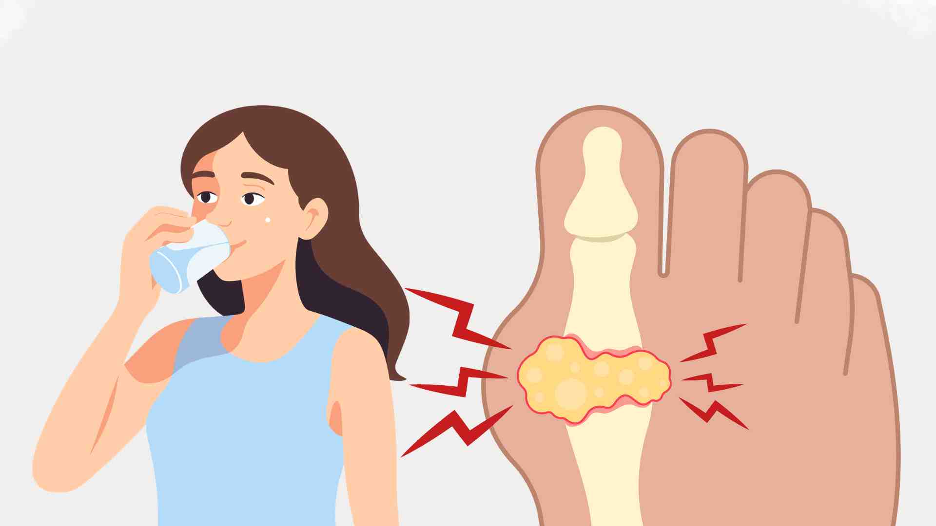 Drinking enough water every day helps the kidneys increase uric acid excretion through urine, limiting the accumulation of urate crystals in the body. Graphic photo: Huong Son/ Photo using AI