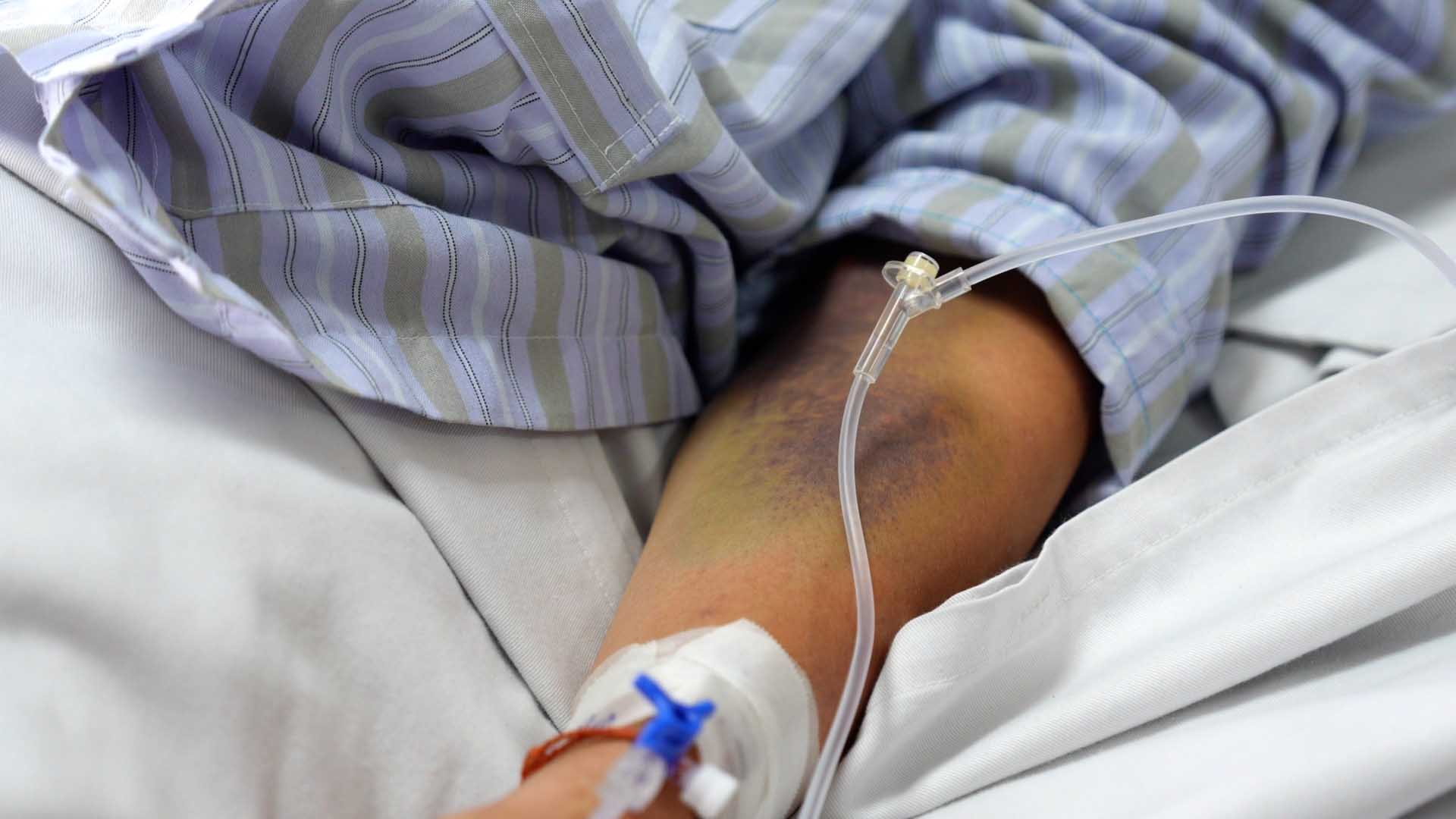 69-year-old woman in critical condition due to dengue fever, doctors warn of high-risk group