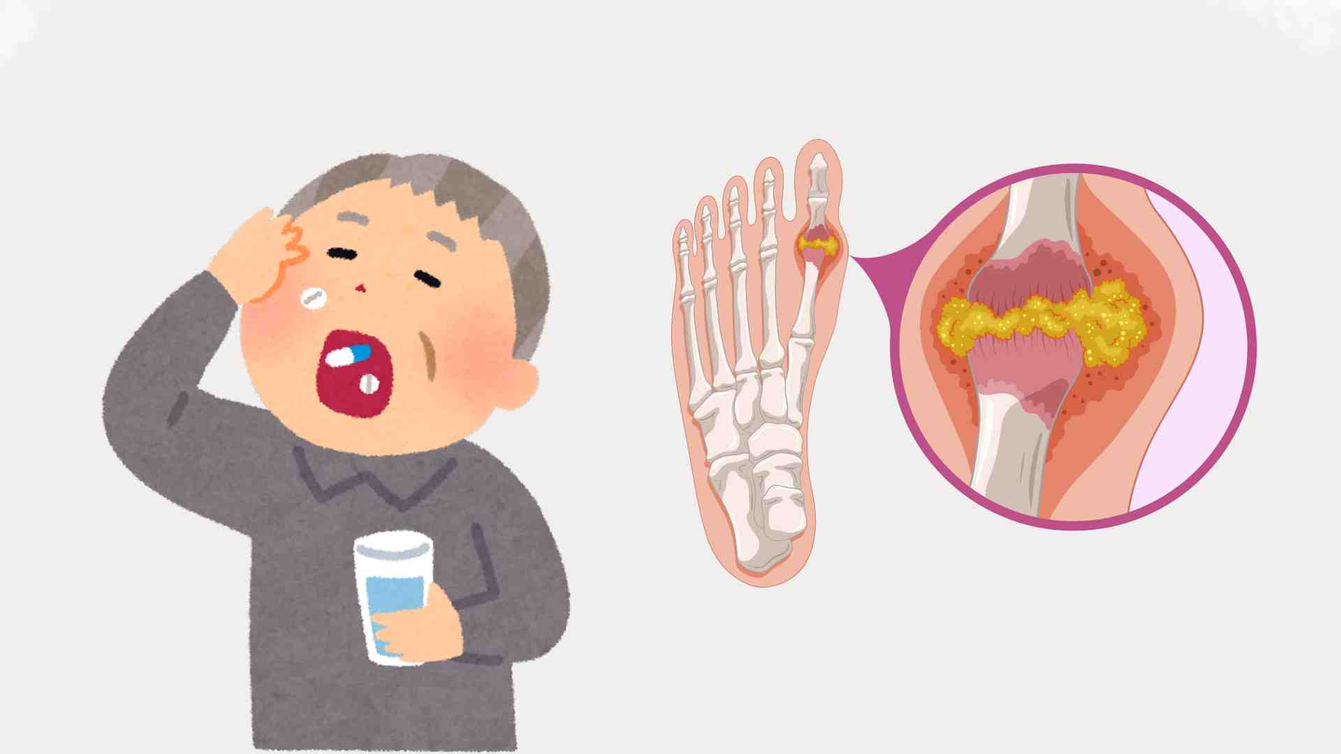 Uric acid-lowering drugs are usually indicated for people with gout with two or more acute gout attacks in a year. Graphic photo: Huong Son/ Photo using AI