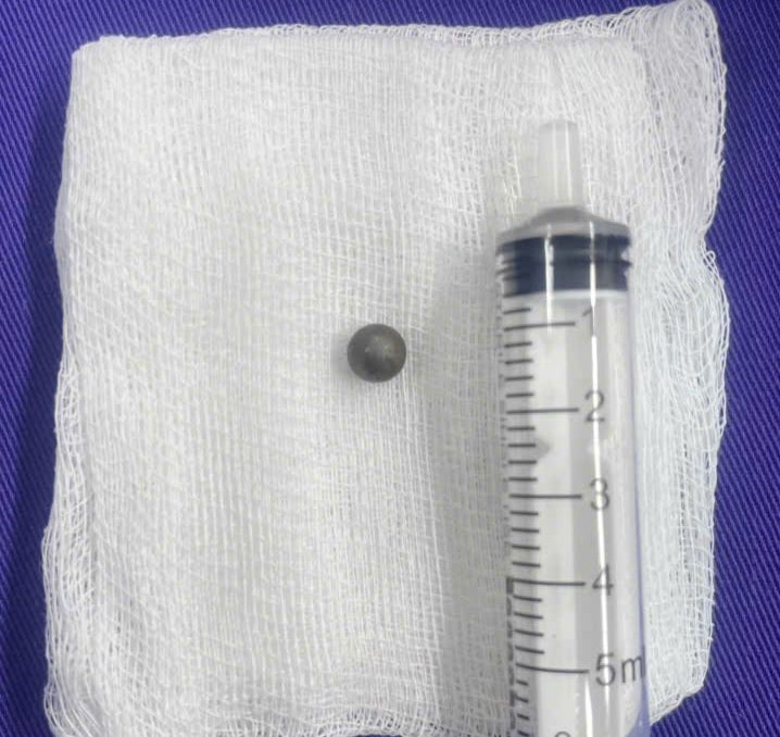 The iron pellet stuck deep in the boy's head was removed. Photo: BVCC