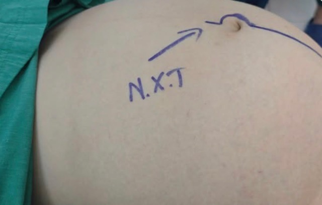 Before surgery, the patient had a rapidly growing ovarian tumor, bloating. Photo: Source Thu Duc General Hospital