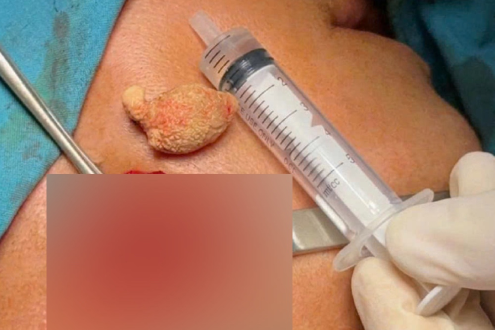 The stones were removed from the hypomandibular gland. Photo: Provided by Can Tho City General Hospital.