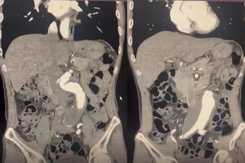 CT scan of blood vessels showed an angular aneurysm of the neck. Photo: Provided by Can Tho City General Hospital.