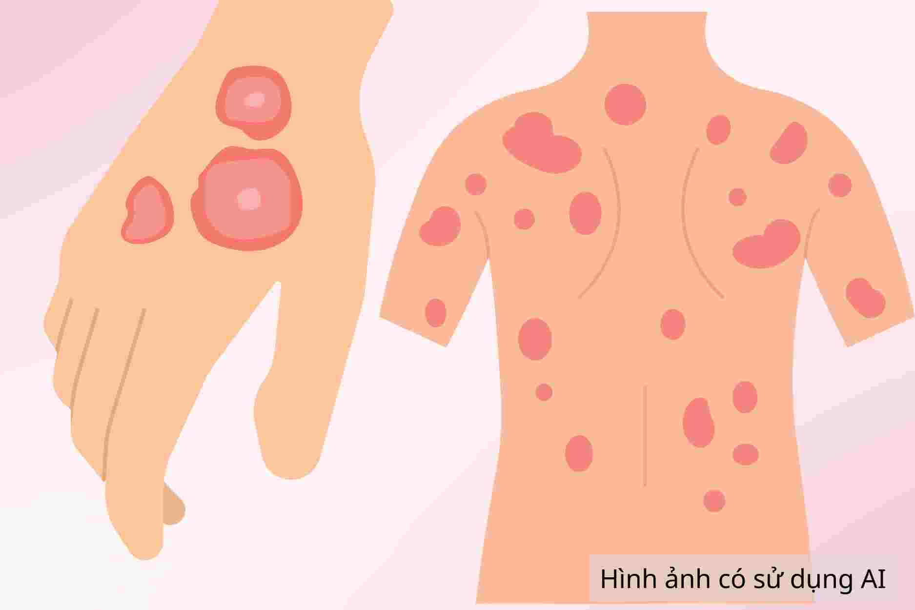 Tell you how to prevent body skin fungus from recurring after treatment