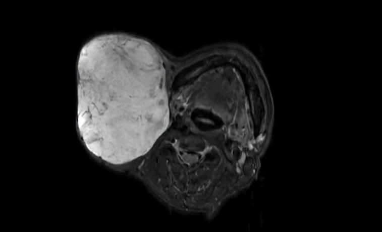Surgery of a parotid gland tumor for a patient. Photo: BVCC