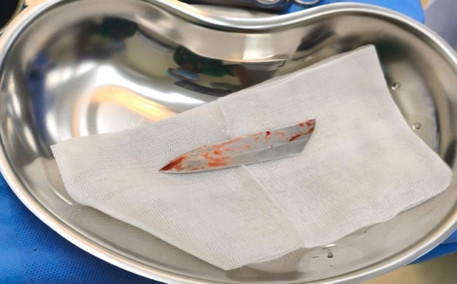 La partie du couteau de plus de 10 cm de long a été retirée avec succès du patient par le médecin. Photo: Fournie par l'hôpital international Minh Anh.