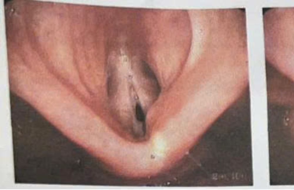 Endoscopic images show severe laryngeal stenosis. Doctors recommend that patients who are being treated for lung diseases, if symptoms of prolonged hoarseness, swallowing choking appear, should go to a medical facility immediately. Photo: Provided by Can Tho City General Hospital.