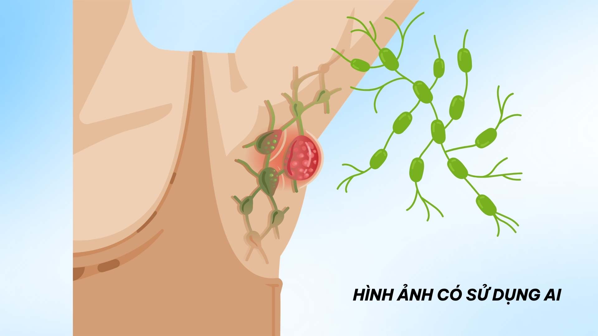 Signs to recognize purulent sweat gland inflammation you should not ignore