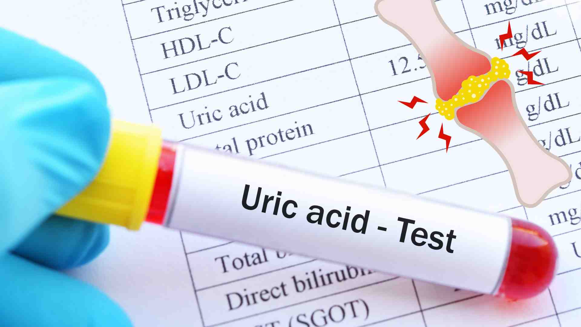 Sudden joint pain and swelling are when uric acid levels increase. Graphic photo: Huong Son
