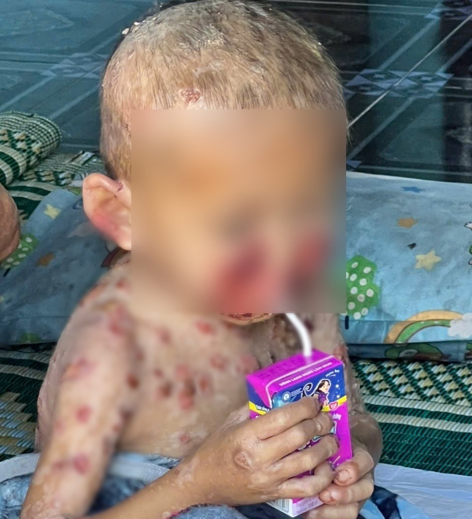 Ho Van Hung in Thanh Bong commune, Quang Ngai province has been suffering from a terrible disease for nearly 5 years. Photo: Minh Huy