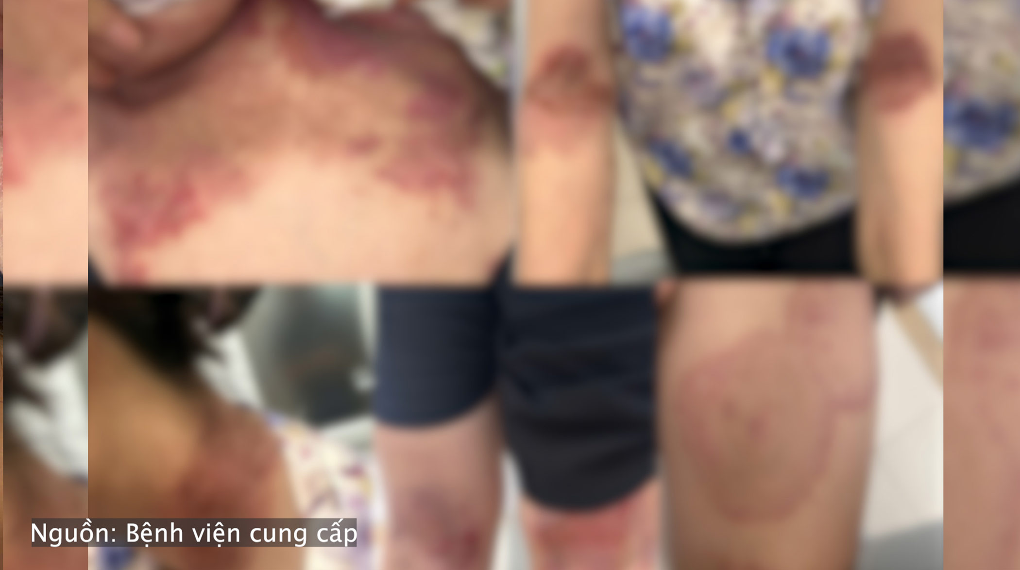 Skin erosion, ulcers, discharge, recurrence many times, be careful of this rare dermatology disease