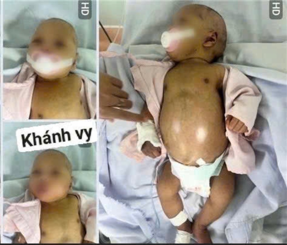 The disease has taken away baby Khanh Vy's health, and also exhausted the economy and health of Mr. and Mrs. Tai. Photo: Family provided