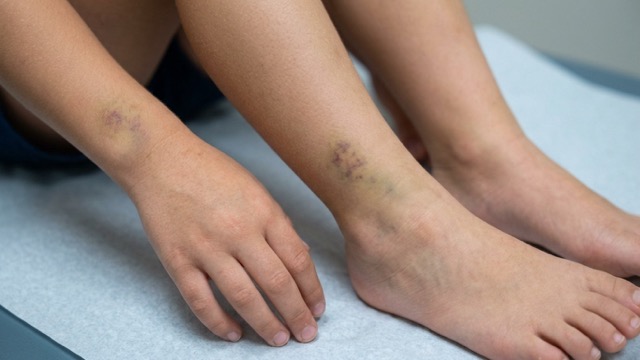 Les parents doivent faire la distinction entre les ecchymoses bénignes et les signes avant-coureurs inhabituels chez les enfants. Photo: Hương Sơn/avec utilisation d'IA