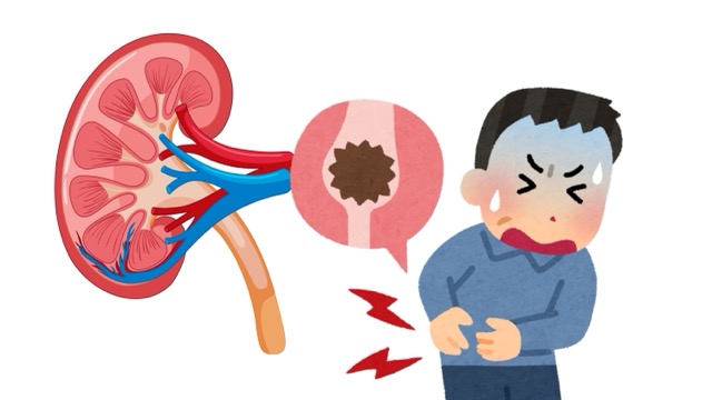 Chronic kidney disease often progresses silently, with few symptoms in the early stages. Photos using AI: Huong Son