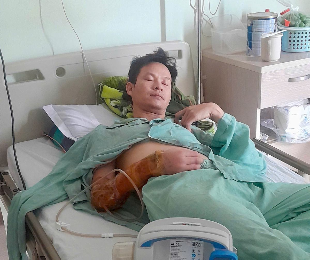 Mr. Bui Quang Hanh (Tien Lang commune, Hai Phong) suffered severe injuries after a workplace accident. Photo: Character provided