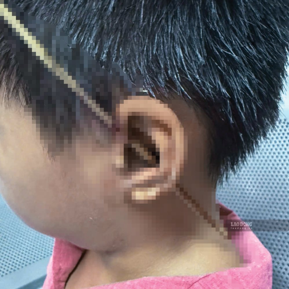 L'enfant a été poignardé à travers le pavillon de l'oreille par un bâton de bambou, il a maintenant été opéré par l'hôpital général provincial de Quảng Trị et est traité de manière stable. Photo: Minh Châu