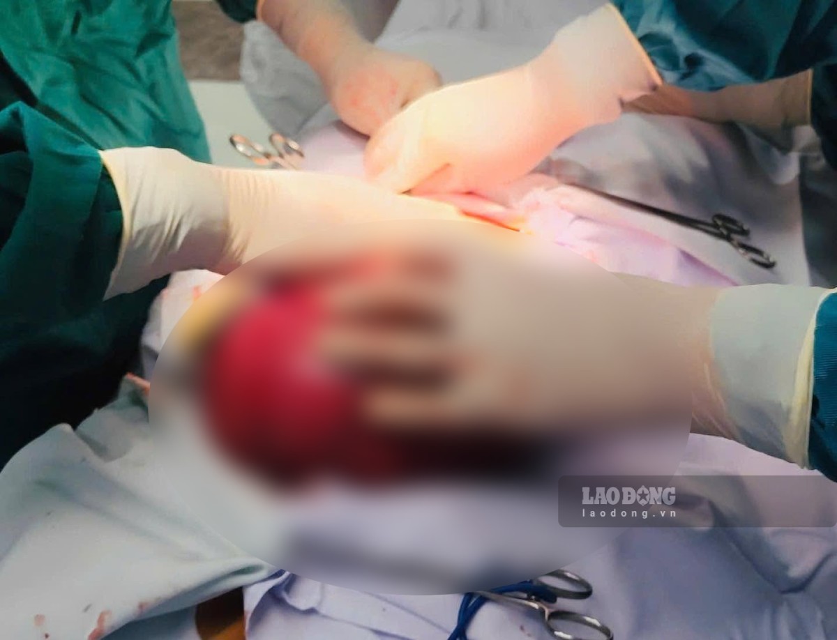 Thai Binh Obstetrics and Gynecology Hospital, Hung Yen province has just successfully operated on and removed a uterine fibroid tumor weighing nearly 3kg for a female patient. Photo: Thai Binh Obstetrics and Gynecology Hospital