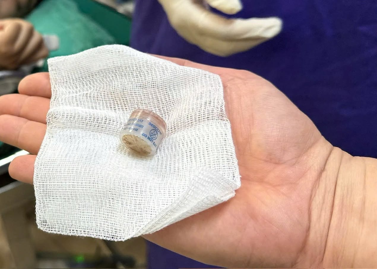 El objeto extraño extraído es una caja antihumedad que el paciente tragó accidentalmente al preparar bebidas para adelgazar. Foto: Hospital Militar Central 108 proporcionada