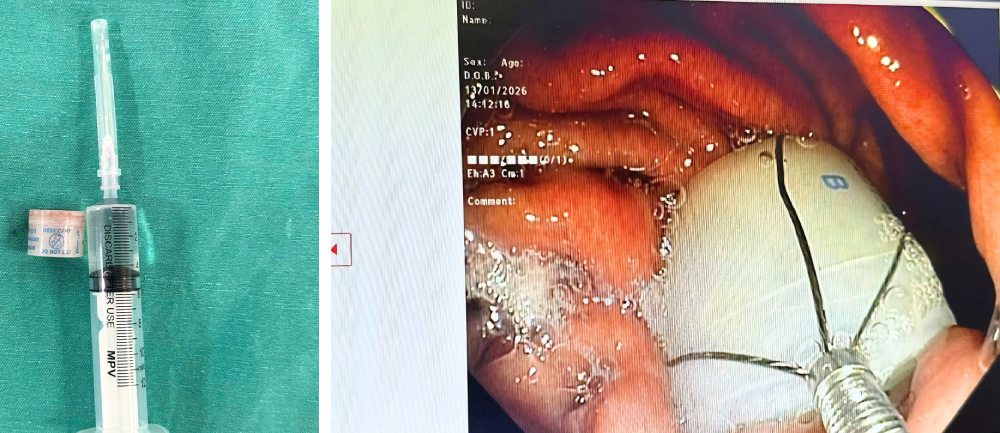 Bác sĩ tiến hành nội soi gắp dị vật. Ảnh: Bệnh viện Trung ương Quân đội 108 cung cấp