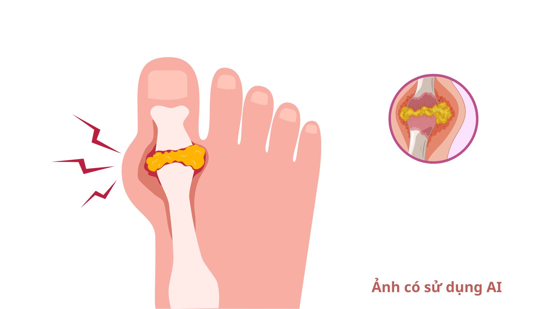 According to experts, increased uric acid is the cause, and gout is the consequence. Photos using AI: Huong Son