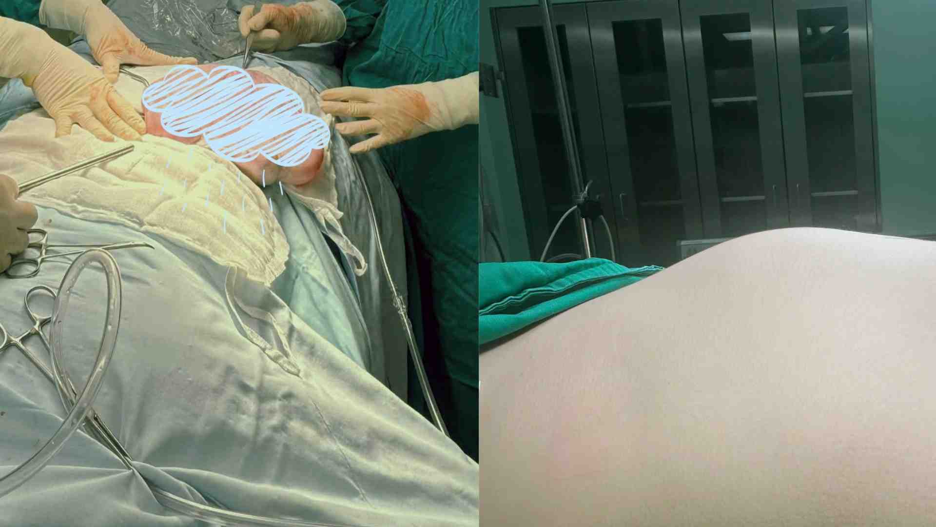 Image of a child with ovarian tumor causing abnormally large abdomen and successfully operated on by doctors. Photo: BVCC