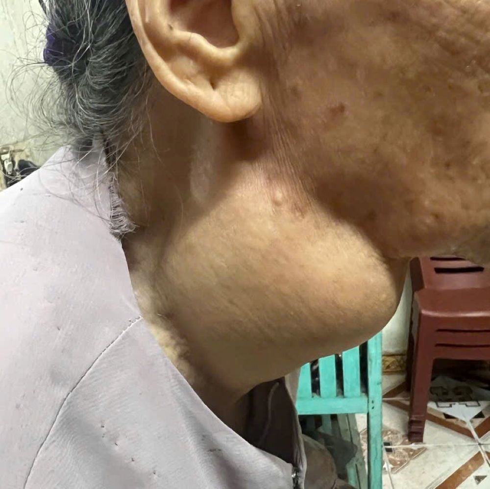  Khối u tuyến giáp khổng lồ gây khó khăn trong hít thở và sinh hoạt hàng ngày cho bệnh nhân.