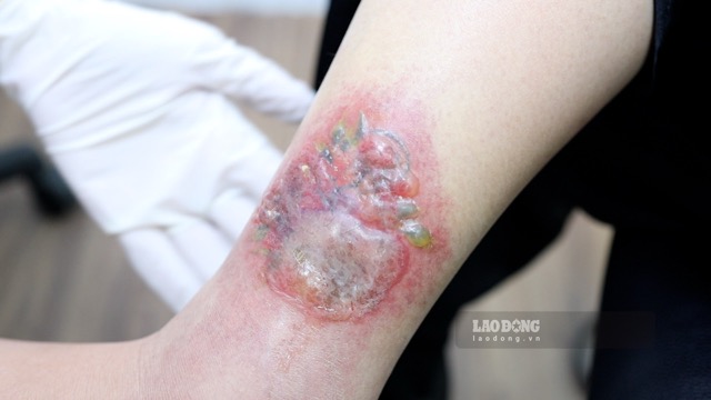 Patient performing cosmetic tattoo removal procedure encounters complications. Photo: Nguyen Ly