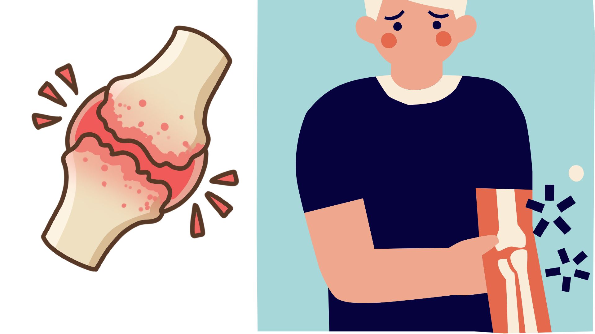 One of the factors increasing the risk of osteoarthritis in young people is excessive or incorrect exercise. Photos using AI: Huong Son