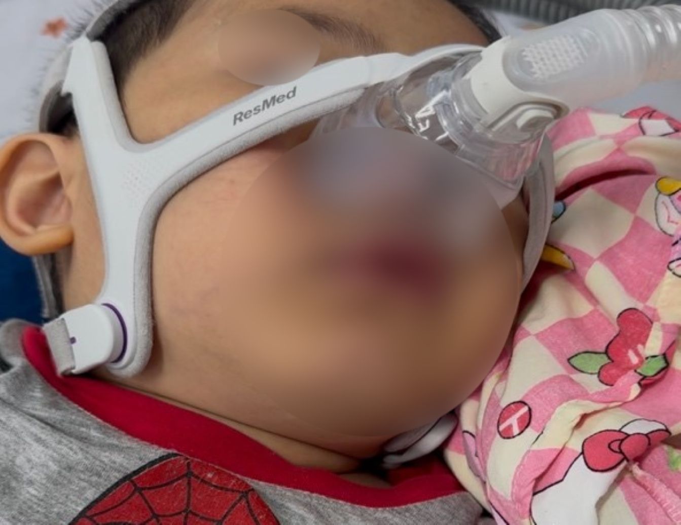 The patient is on a BiPAP (non-invasive positive pressure) ventilator. Photo: Provided by Children's Hospital 1