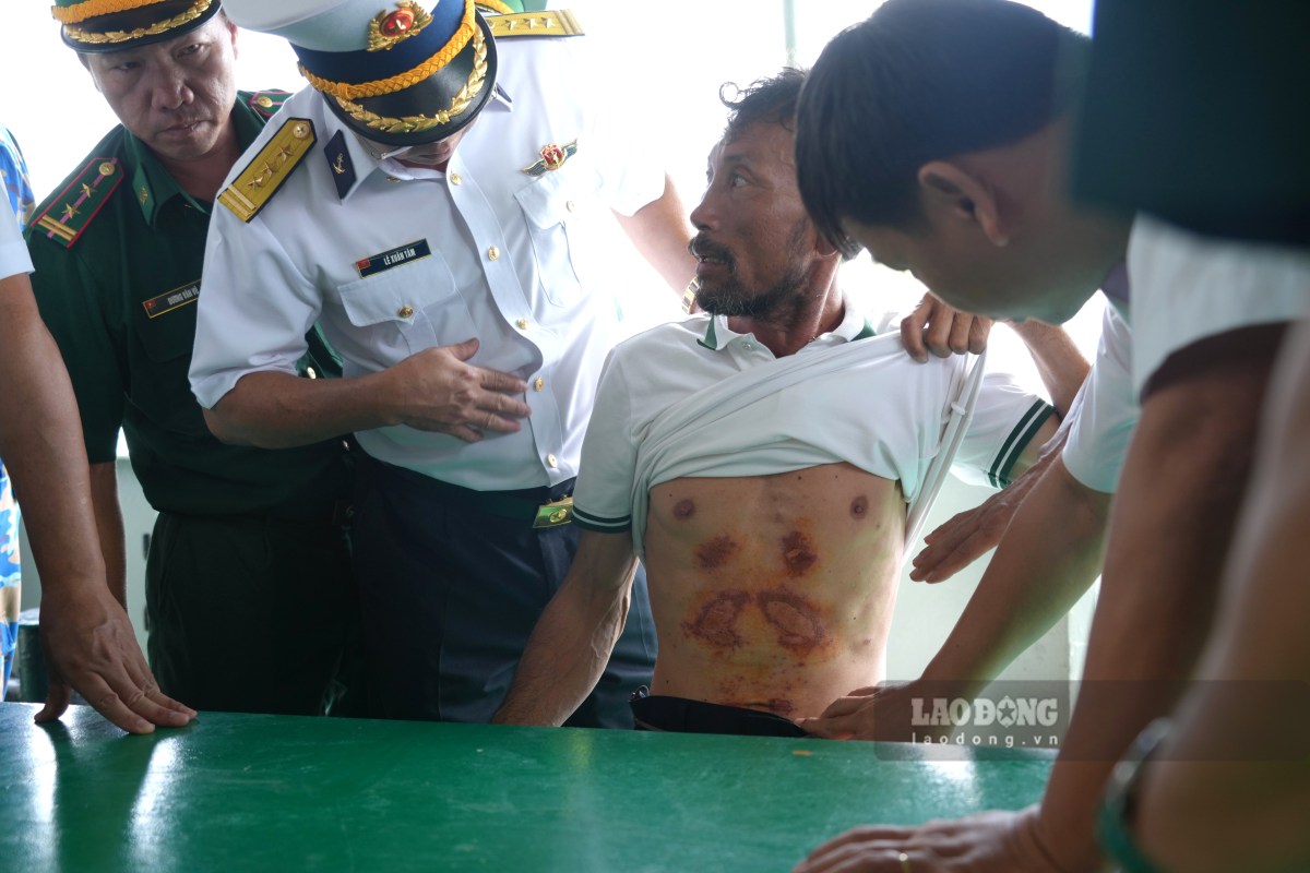 Vùng bụng của anh Chung bị xây xát do ma sát với tấm sốp trong quá trình trôi dạt trên biển. Ảnh: Thành An