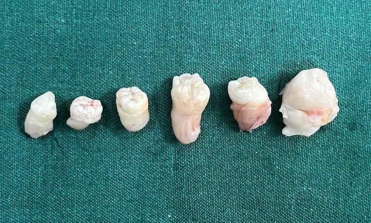 6 teeth were discovered in the ovarian tumor of the female patient. Photo: Trieu Hai Regional General Hospital