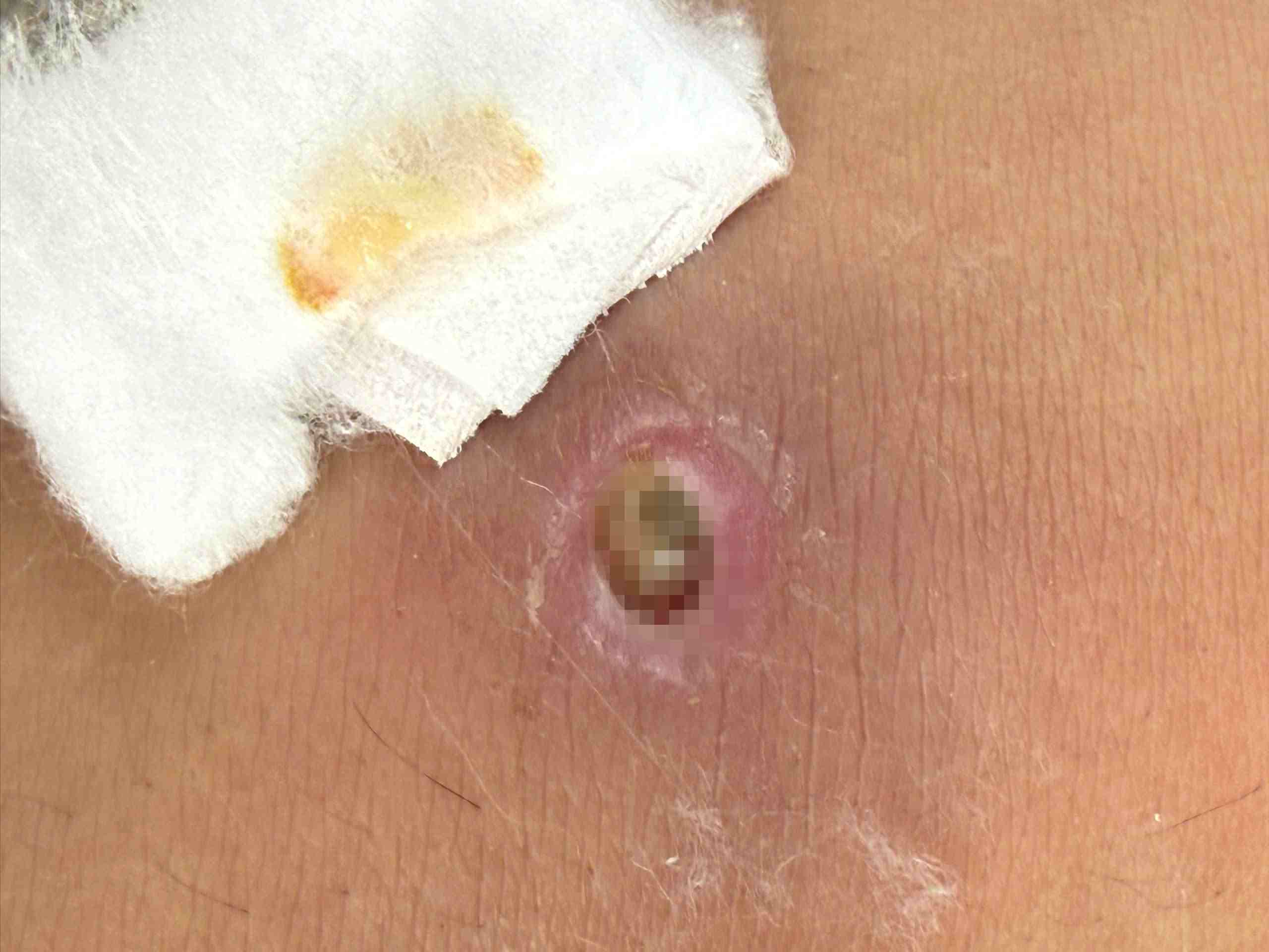 Deep pit-shaped lesions on the arm of a patient with dragon worms. Photo: BVCC