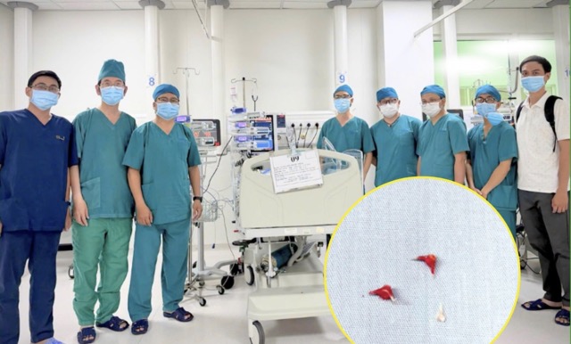A team of doctors from two hospitals coordinated to successfully remove a foreign object, an eel bone, deeply rooted in the bronchi, causing a 7-month-old infant to have respiratory failure. Photo: Children's Hospital 2