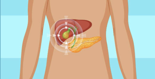 The link between obesity and gallstones. Graphics: Thuy Duong