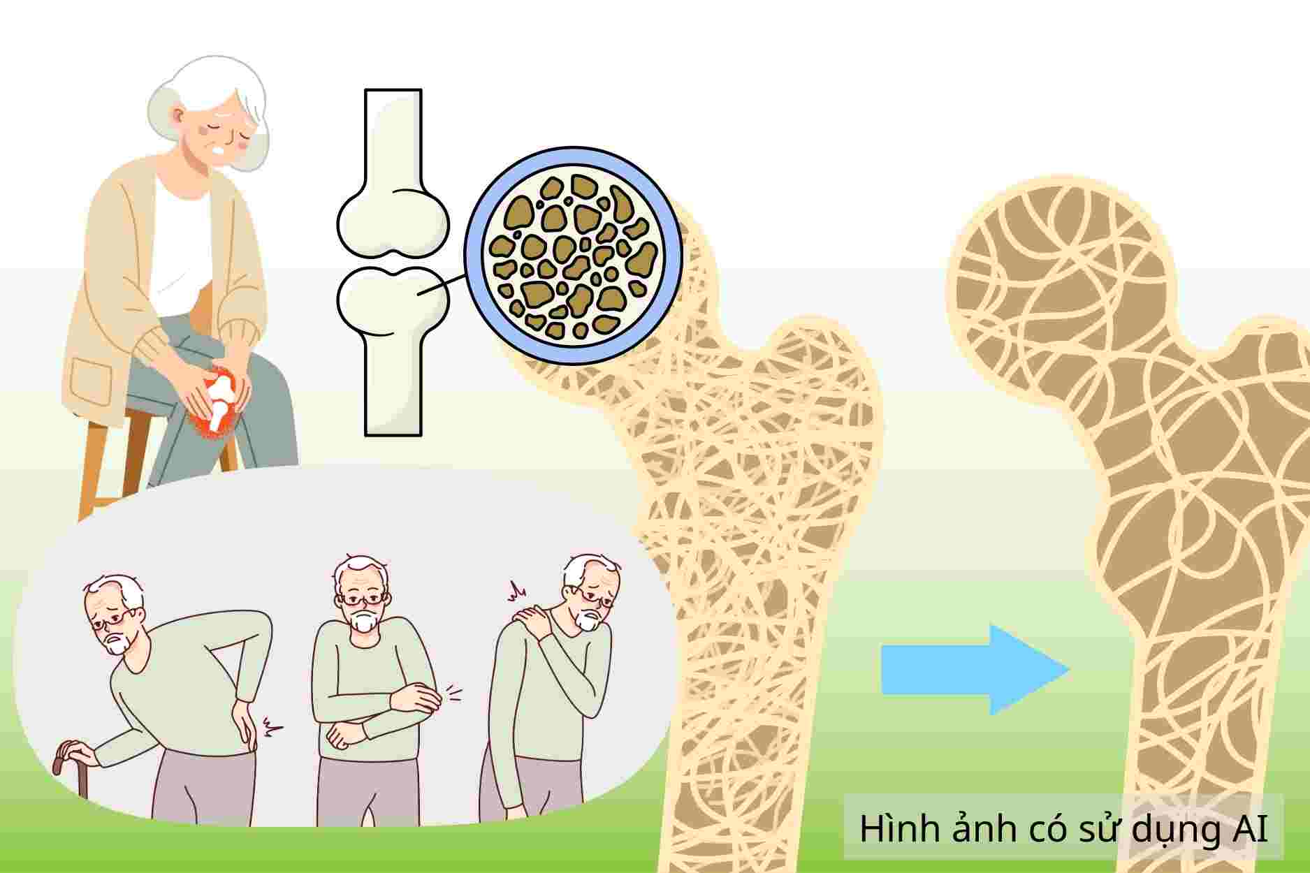 Dangerous complications of osteoporosis