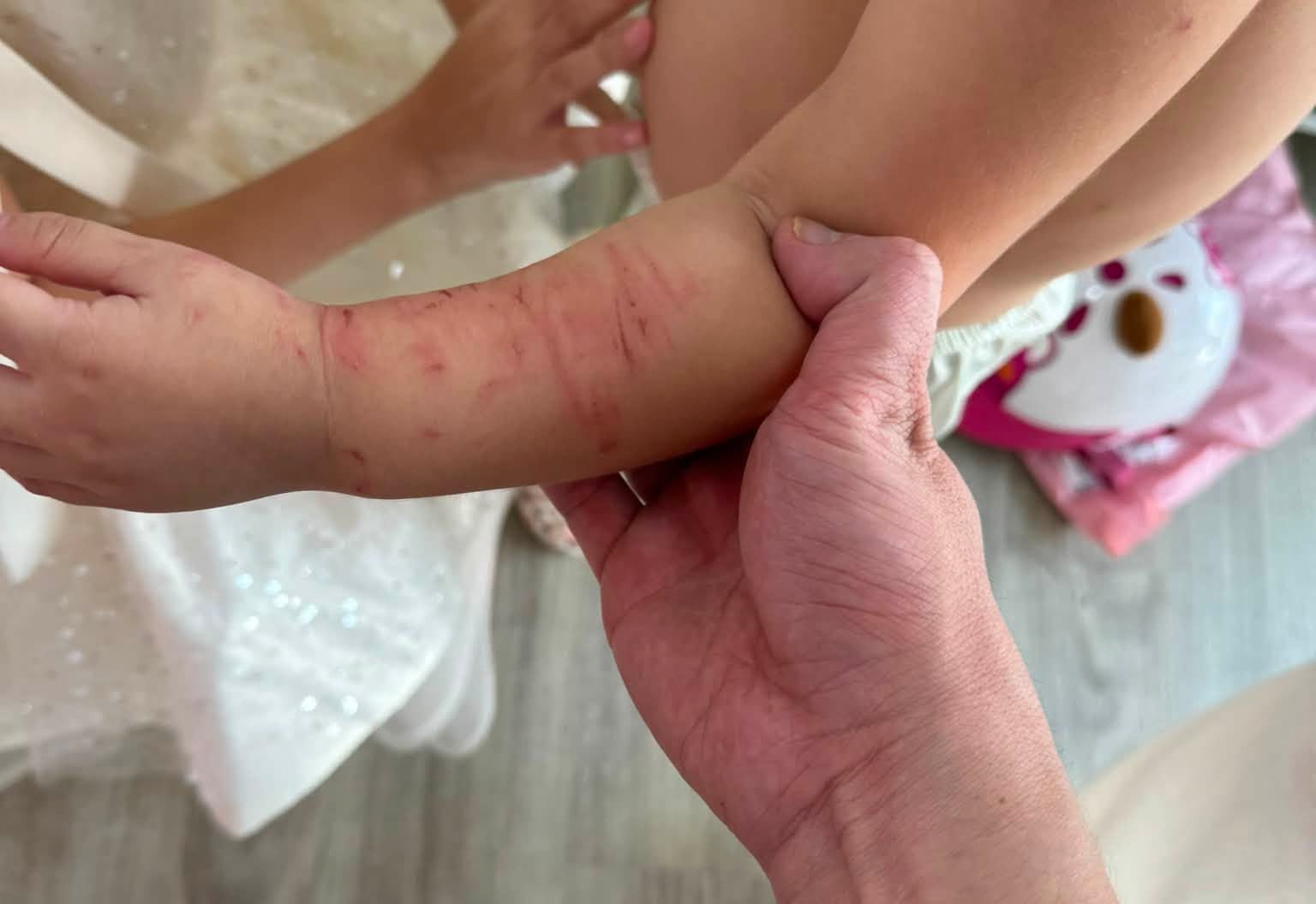 Nha Trang ward authorities will establish an inspection team for the case of a child being scratched by a friend at a private kindergarten. Photo: Van Quy