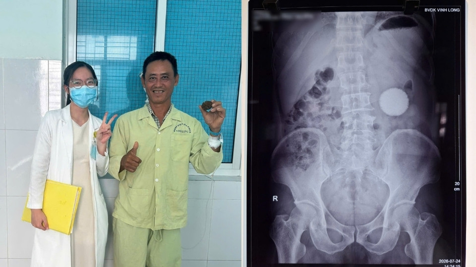 Un cálculo ureteral gigante de unos 5,5 cm de largo y casi 100 g de peso fue extirpado después de una cirugía exitosa. Foto: Hospital General de Vinh Long