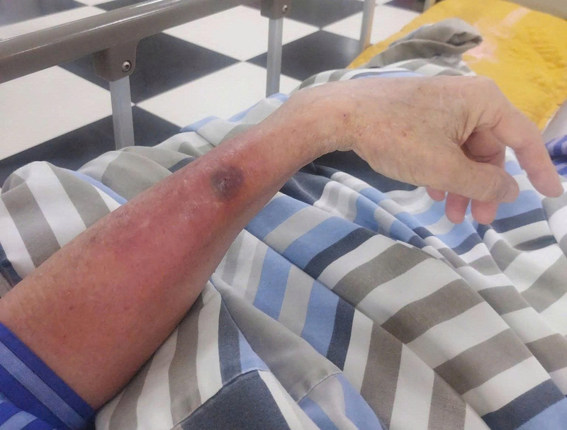 An elderly man's forearm was necrotic after being infected with bacteria living in water. Photo: Lang Son Provincial General Hospital