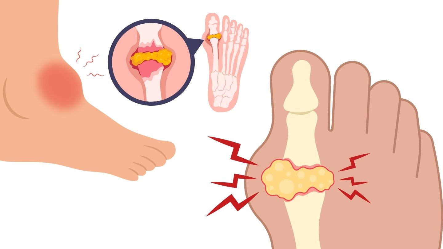 Deposition of urate crystals can continue to cause inflammation and joint damage even when the patient no longer feels pain. Graphic photo: Huong Son/AI used