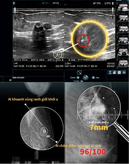Image of damage on an ultrasound and mammographic film of the breast with integrated AI of Ms. Thanh. Photo: Nura