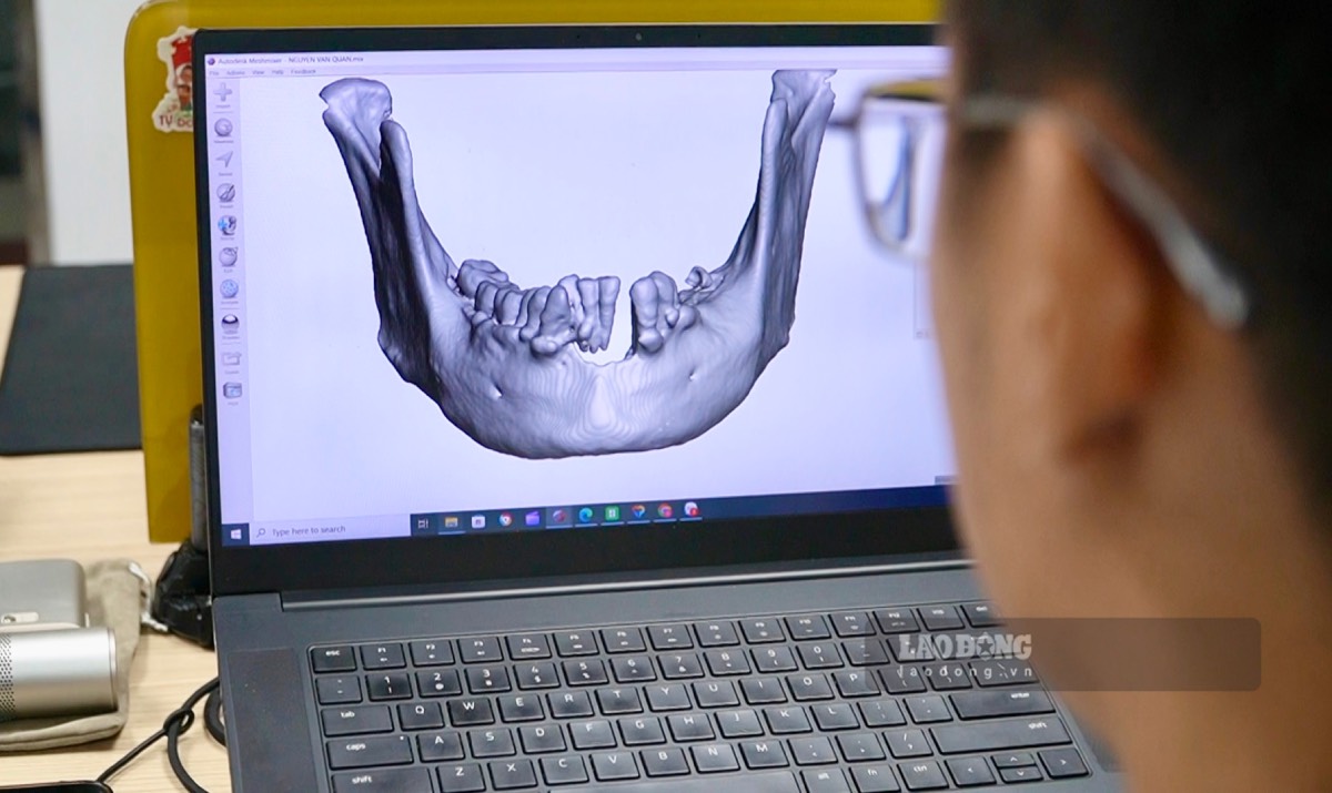 Mỗi người bệnh đều có những thiết kế 3D riêng trước khi phẫu thuật. Ảnh: Mai Anh.
