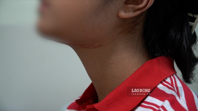 Patient Khanh Trang is one of the patients with tumors and cancer at the hospital who had successful facial surgery. Photo: Mai Ly