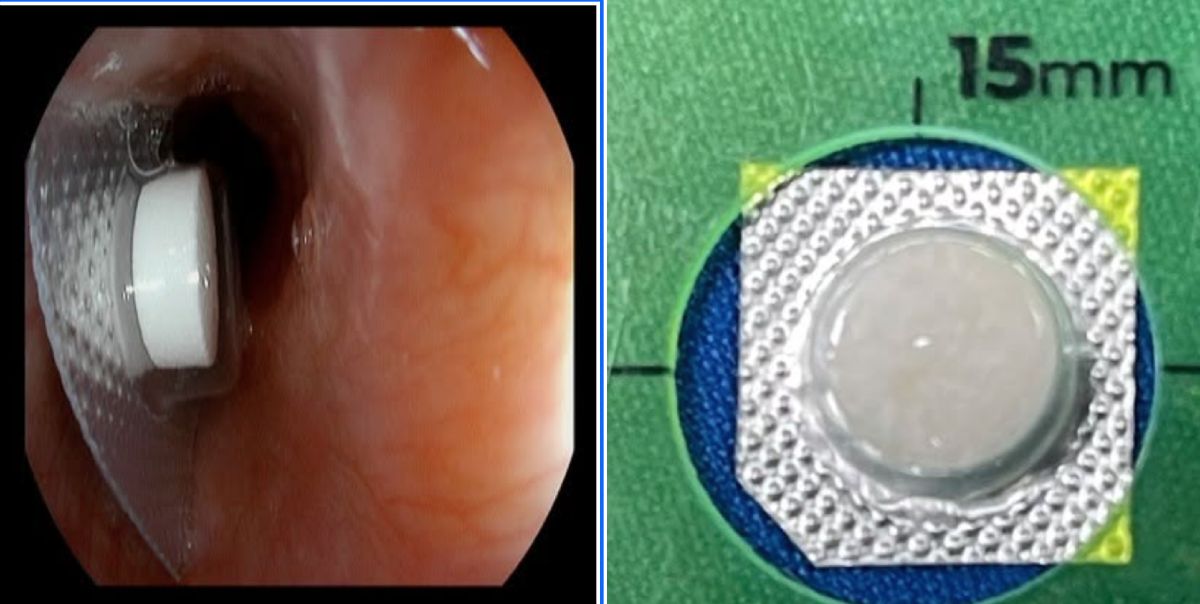 The pill is still in a film blister in the patient's esophagus. Photo: Hung Yen Provincial General Hospital