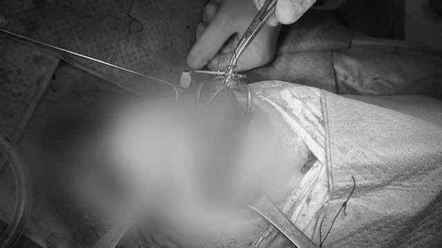 Pacientes con cáncer de lengua se regeneran con una herida promovida por un corte de piel muscular debajo de la uña. Foto: Hospital Militar 175 proporcionada