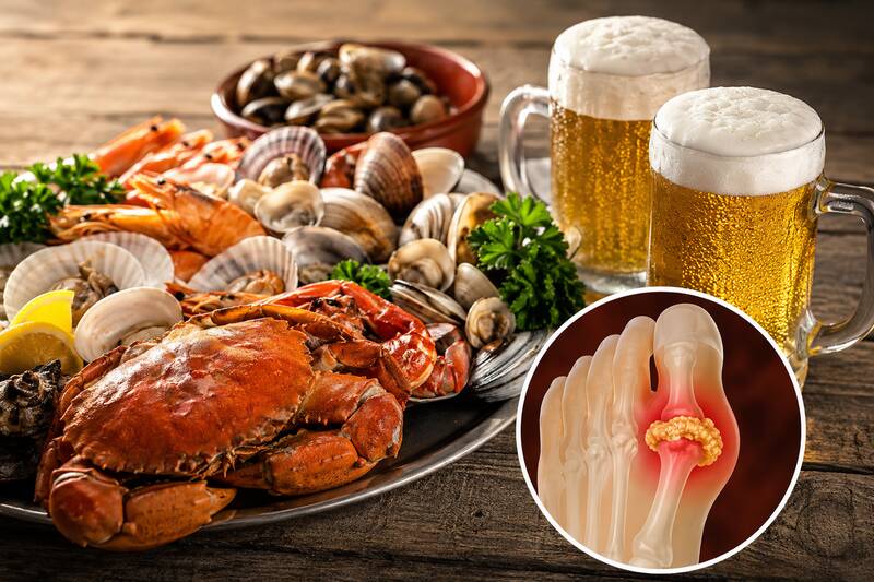 Not only increasing uric acid, beer also hinders the detoxification process, increasing the risk of gout when combined with seafood. Photo supported by AI