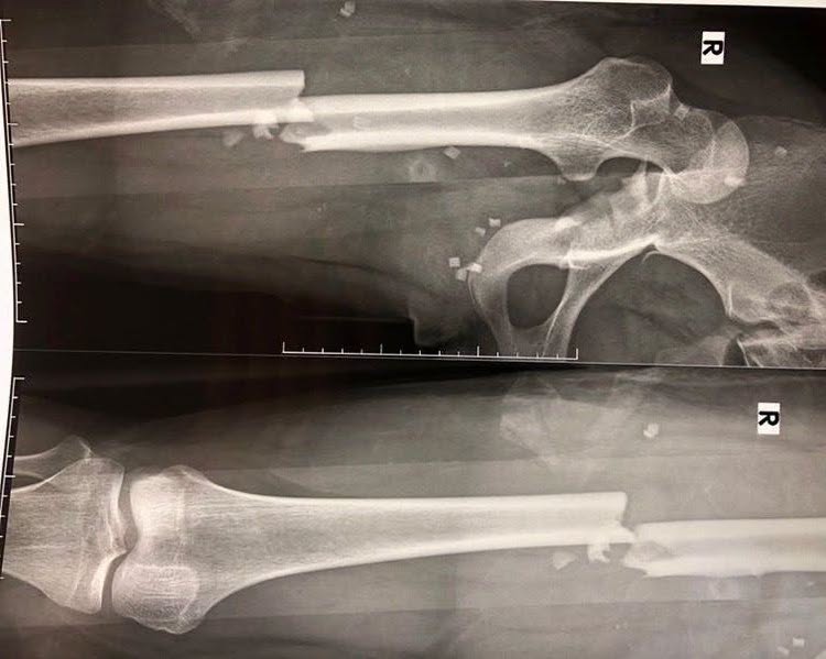 Un cas de fracture du corps de l'os fémoral dévié après un traumatisme dû à un accident de la route est traité activement par les médecins. Photo: Hôpital général provincial de Khánh Hòa