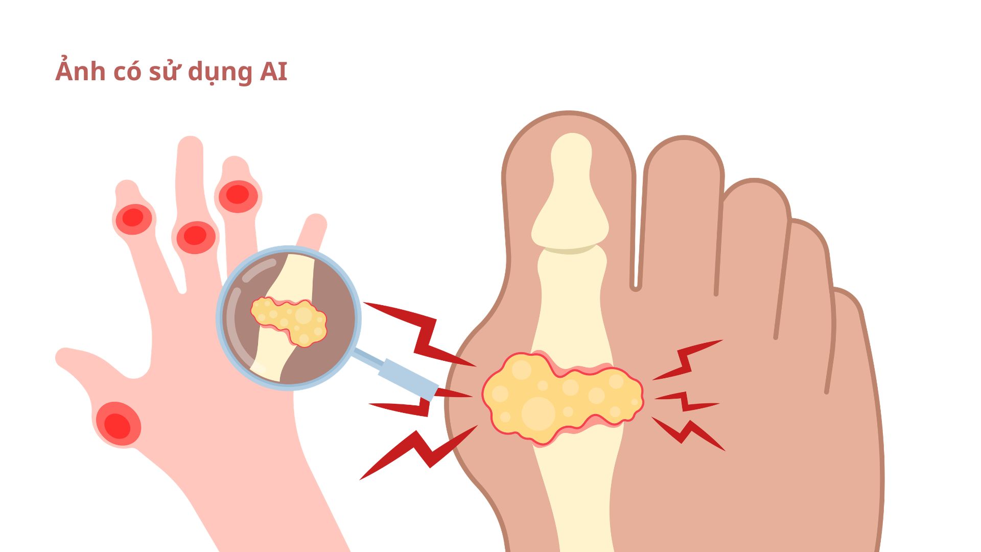 When the uric acid level in the blood increases, urate crystals will form and deposit in the joints. Image using AI: Huong Son